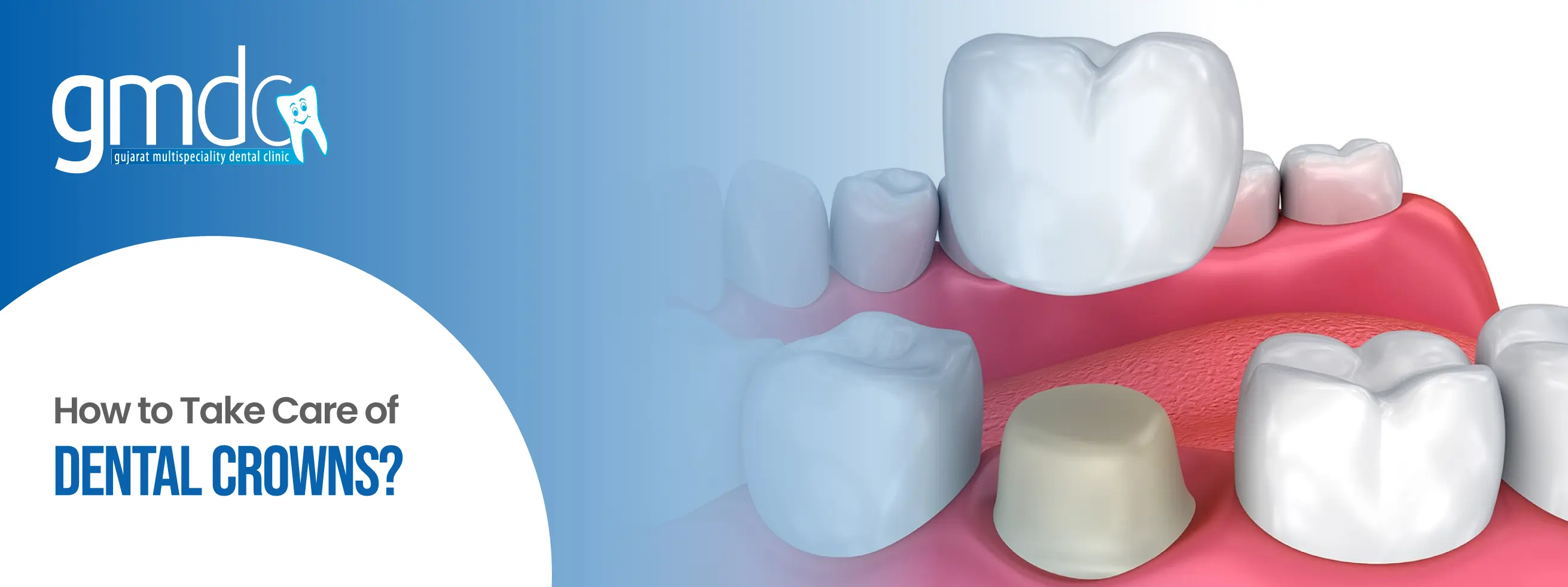 dental crowns